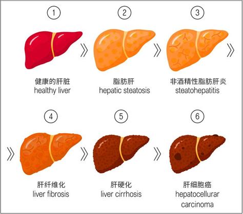 肝不好有哪些症状|肝病的九个早期症状，你有几个？